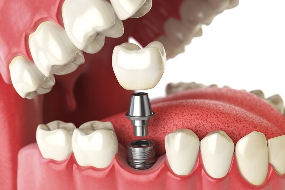 Can Dental Implants Be Done In One Day?