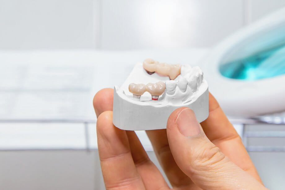 How Do You Clean & Floss a Dental Bridge?