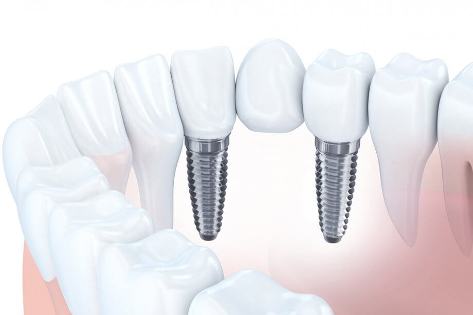How Long Do Dental Bridges Typically Last?