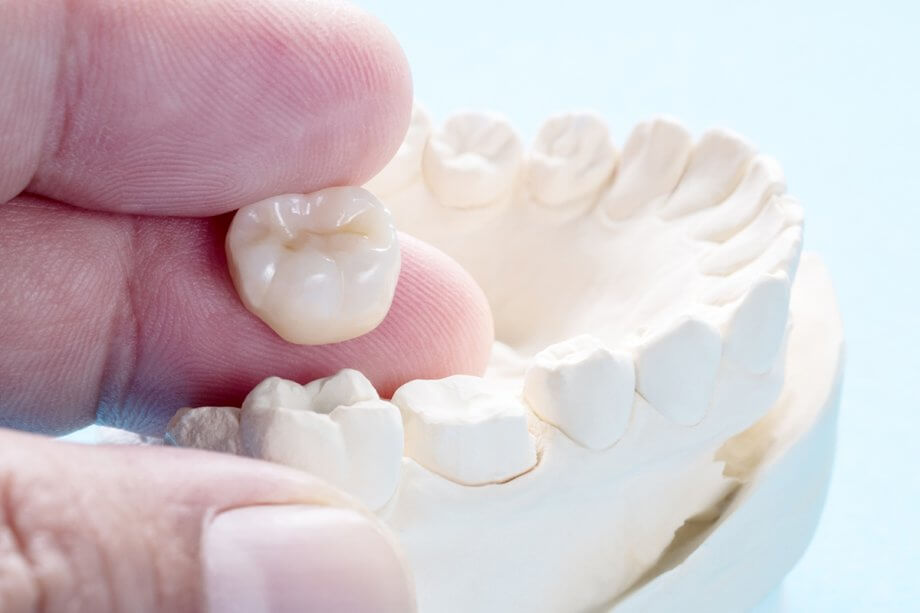 How Long Does it take to Get a Dental Crown?