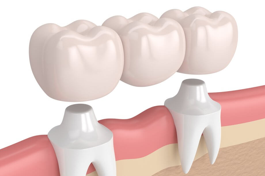 How Long Does It Take To Get Used To A Dental Bridge?