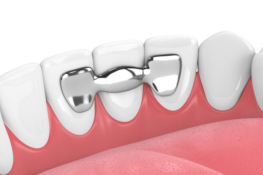 What Are Dental Bridges And How Do They Work?